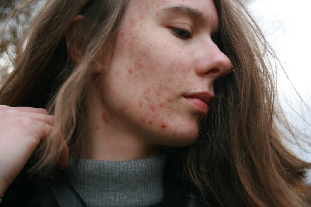 Is Virgin Coconut Oil Good for Acne-Prone Skin? 2 acne, virgin coconut oil, skin, essential oil