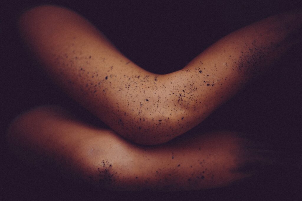 Is Virgin Coconut Oil Good for Acne-Prone Skin? 3 acne, virgin coconut oil, skin, essential oil